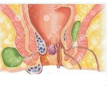南寧哪個(gè)醫(yī)院可以做肛周膿腫？