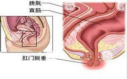 南寧治療脫肛哪家醫(yī)院好？南寧脫肛治療多少錢？